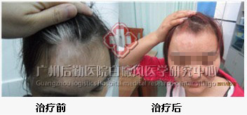 治愈遗传白癜风 在这里点燃希望