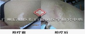 当理想遭遇白癜风,“悲剧”少年重获新生