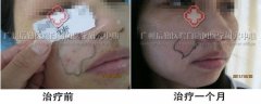女性面部久治未愈白癜风
