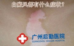 局限型白癜风注意什么